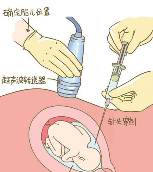 羊水孕期亲子鉴定 羊水孕期亲子鉴定